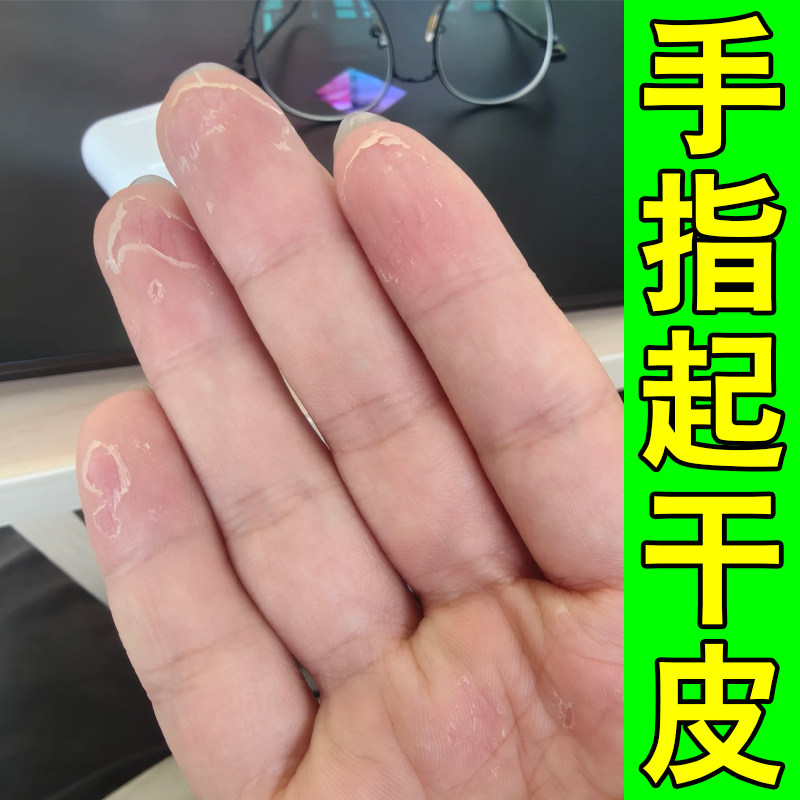 手指头起干皮真菌干燥粗糙起皮手足开裂口子手掌心手指蜕皮掉皮药