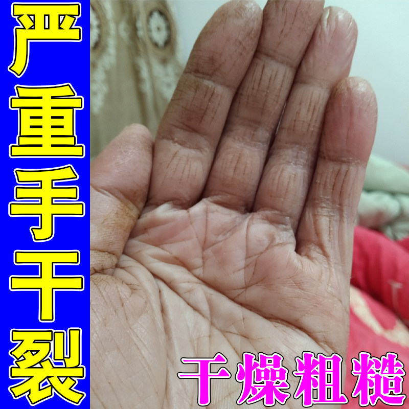 手干裂起皮脚后跟裂口手指干燥粗糙开裂防裂修复手霜