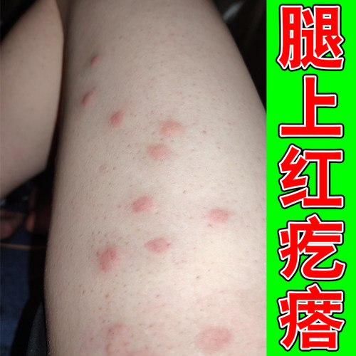 腿上红疙瘩皮肤过敏红肿身上痒起红疙瘩蚊虫叮咬刺挠痒外用修复膏