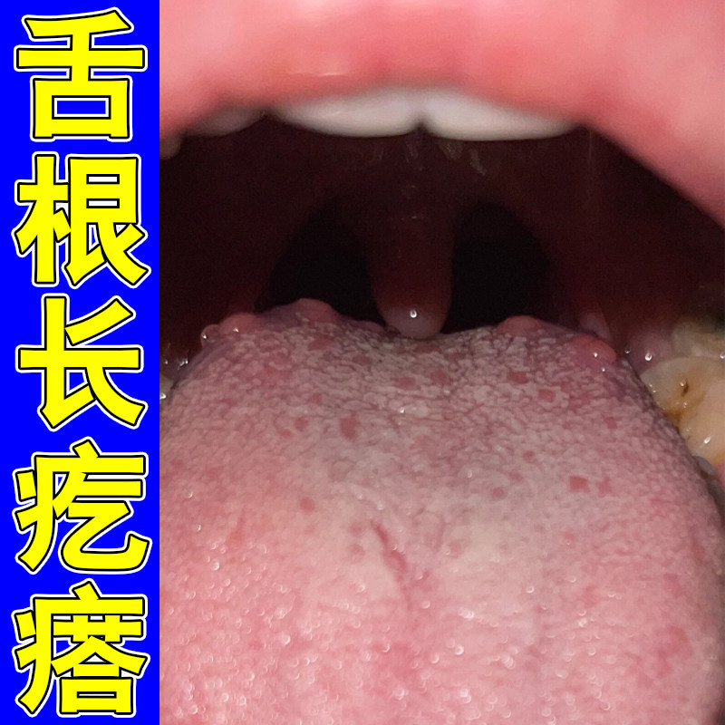 舌根长疙瘩滤泡增生专用喷剂舌头白厚舌尖疼痛红肿干痒草本修复药