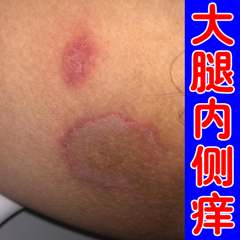大腿内侧皮肤长红斑男士股私处痒红疙瘩腿内侧干燥粗糙痒外用膏