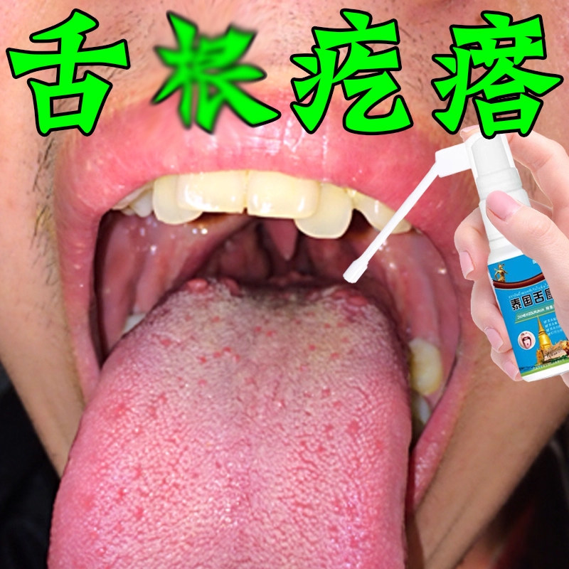 舌根长疙瘩小肉球疼痛喉咙滤泡增生吞咽有异物肿痛修复喷剂
