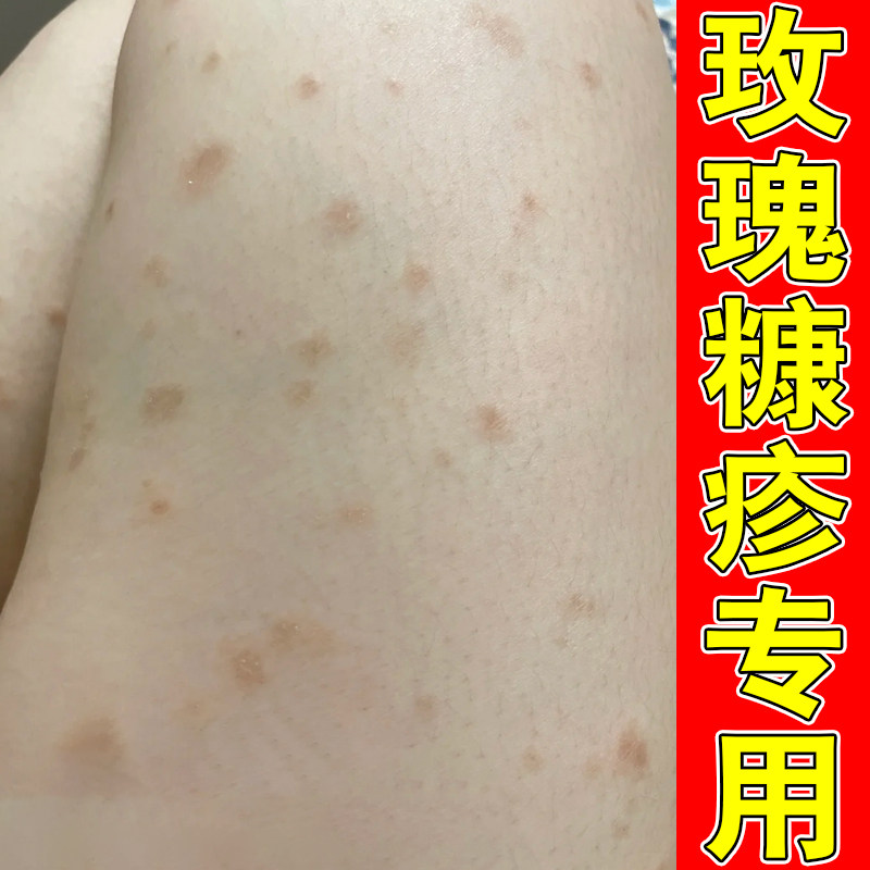 玫瑰糠小腿腿部干燥起鳞屑身上起红疙瘩外用膏