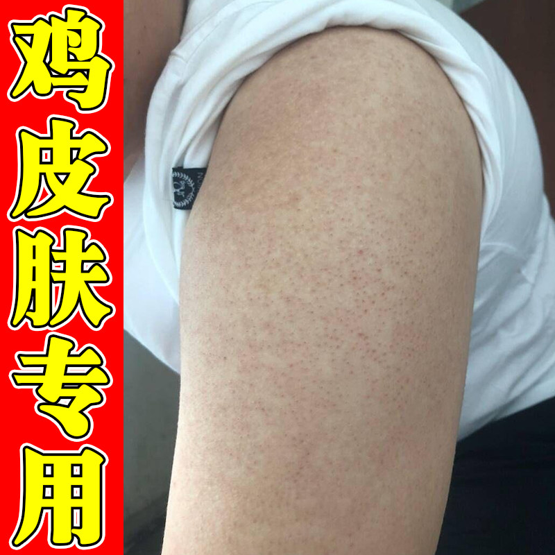 鸡皮疙瘩专用膏手臂毛囊堵塞长小红点疙瘩毛周角化症干燥粗糙药霜
