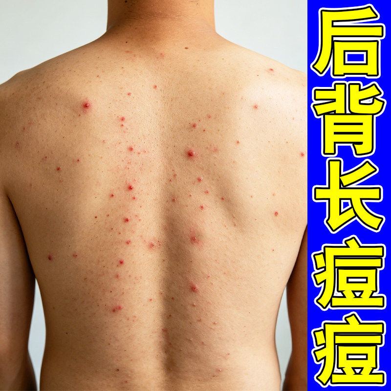 后背长痘痘后背毛囊炎红肿身上痒起红疙瘩去前胸后背痘除