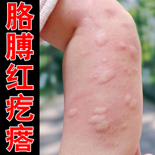 蚊虫叮咬疙瘩腿上痒起红点痒外用药身上痒起红疙瘩小腿痒外用软膏
