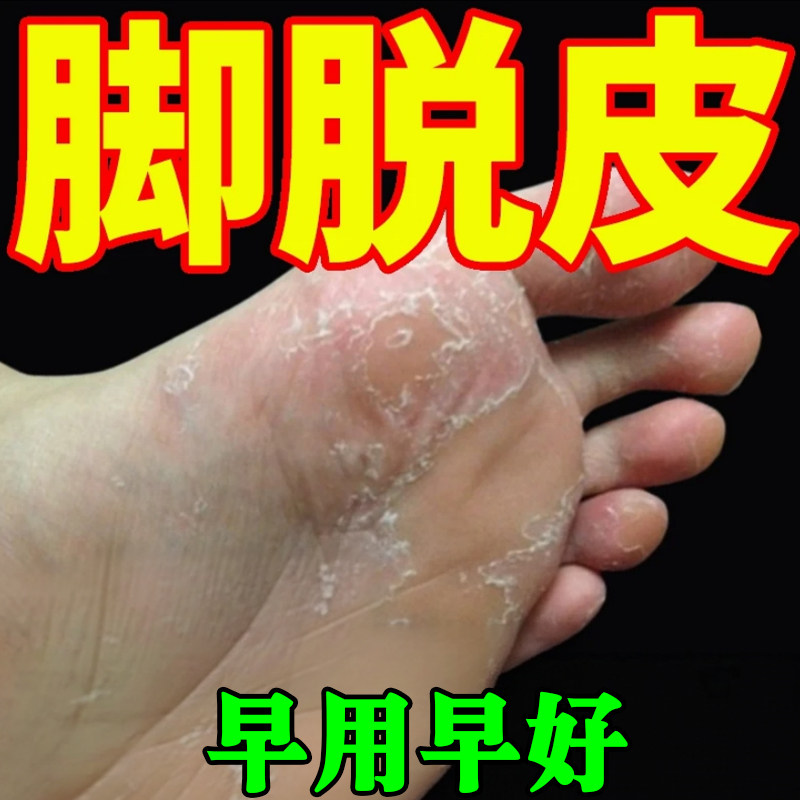 脚掌脱皮脚底脚心掉皮脱皮专用膏脚皮肤粗糙干燥干裂去老茧水泡药