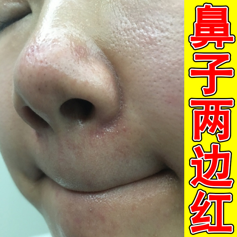 鼻子两边红螨虫痘油腻鼻翼两侧泛红干燥粗糙起皮掉屑修复软膏