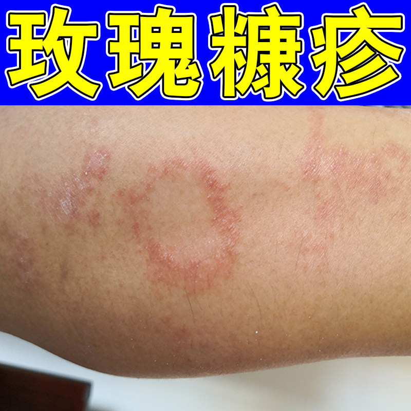 玫瑰糠药专用膏白色糠日光性紫外线晒伤过敏脂溢炎痒外用乳膏