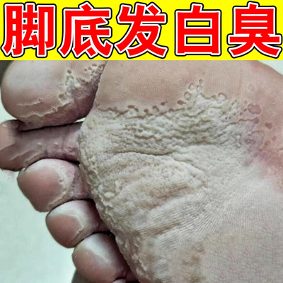 脚底板发白脚臭蜂窝状小孔窝状脚底多汗沙虫脚发臭窝状角质松解症
