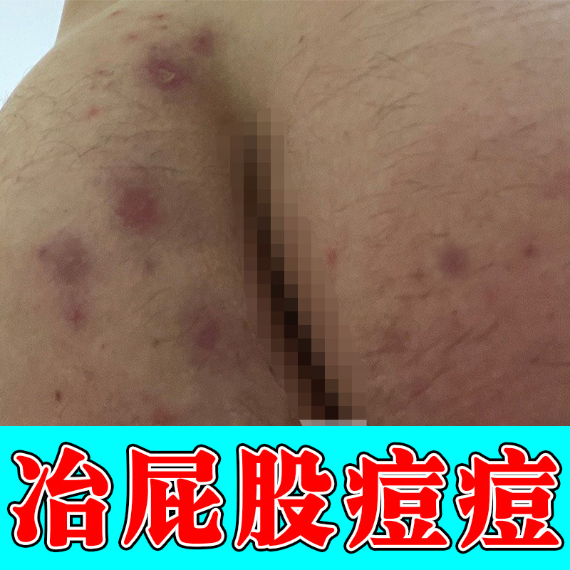 冶屁股痘痘红肿疙瘩冶久坐坐板屁股上长痘痘痒起热疙瘩火疖子软膏