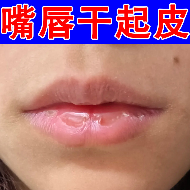 嘴巴发干起皮嘴唇掉死皮唇周粗糙起皮秋冬唇部滋养舒缓干痒裂紧绷