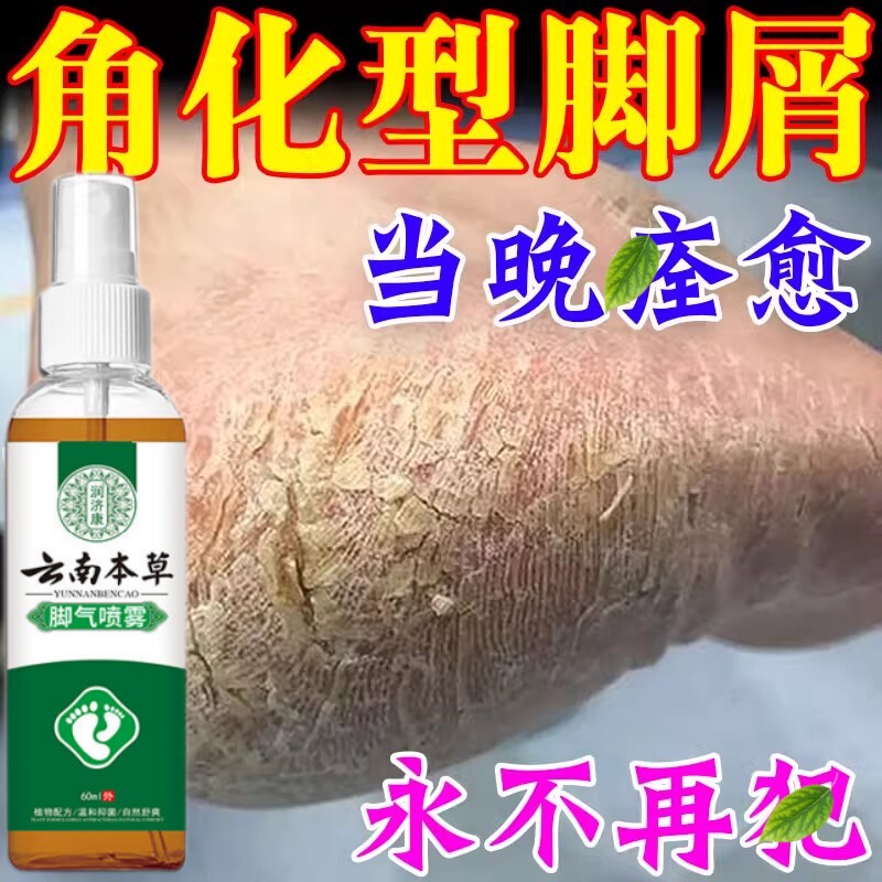 角化型脚气喷雾止痒脱皮烂脚丫真菌感染手足藓脚后跟增厚硬化干裂