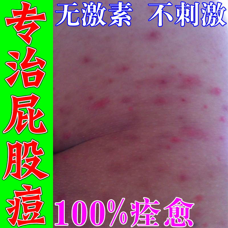 治屁股上长痘痘痒起热疙瘩臀部坐疮脓包火疖子专用抑菌拔毒祛痘膏