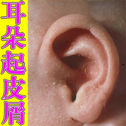 冶外耳道皮屑耳朵粗糙干痒专用草本乳膏外耳道干燥起皮屑发痒