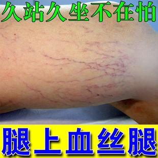 去除女性腿上有红血丝下肢血管堵塞青筋凸起毛细血管扩张专用乳膏