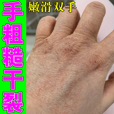手上起皮干燥脱皮手背开裂起皮膏滋润保湿防手裂口愈合膏