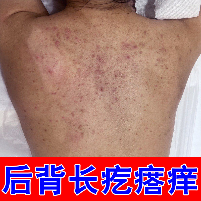 冶后背长痘痘毛囊堵塞严重专用草本乳膏胸前后背长痘痘胸口发痒