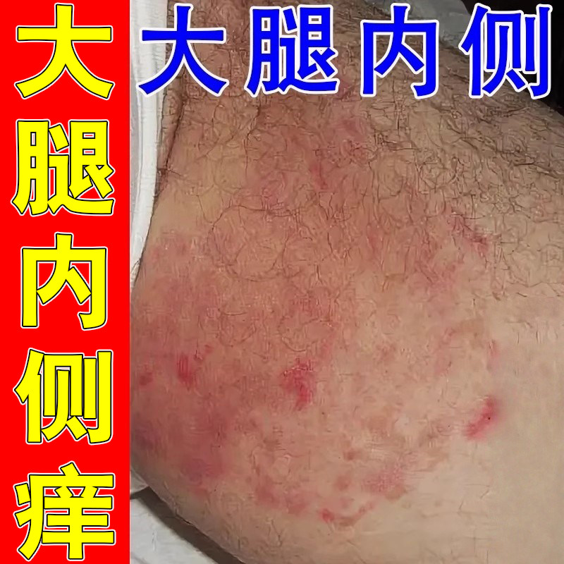 股藓专用 大腿内侧皮肤痒男士屁股淹红潮湿慢性真菌染膏,洗护清洁剂/卫生巾/纸/香薰,身体乳液,淘宝优惠券,粉丝福利购,淘宝优惠卷