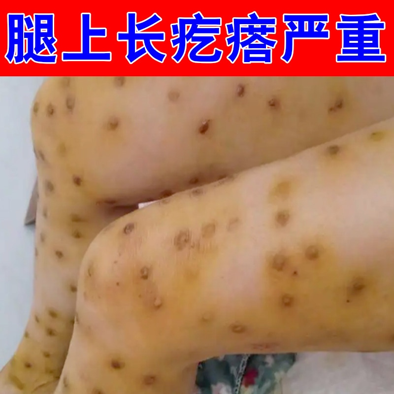 腿上长疙瘩严重皮肤痒干燥过敏专用小腿手臂长疙瘩修护草本乳膏