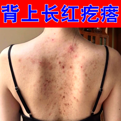 后背长小红疙瘩毛囊堵塞皮肤痒长痘痘专用草本乳膏胸口后背长疙瘩