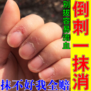 去手指倒刺营养油手上起刺指甲边缘去死皮修复霜防长肉刺护理神器