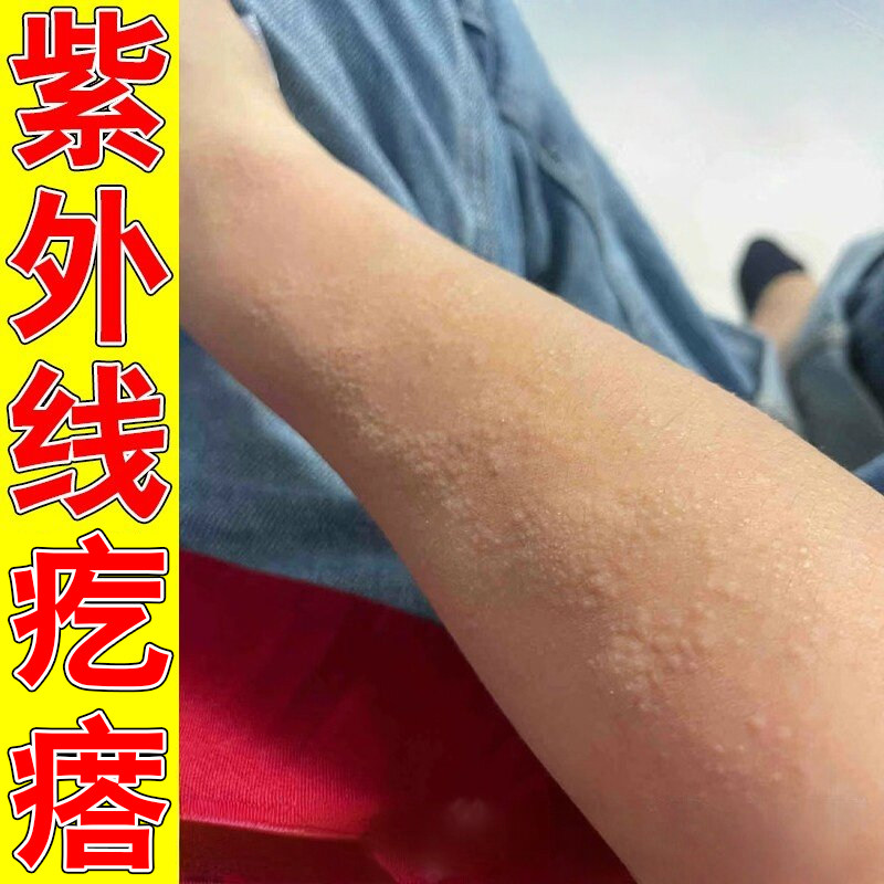 冶皮肤长小疙瘩外用顽固无激素晒伤修复膏太阳晒伤发痒