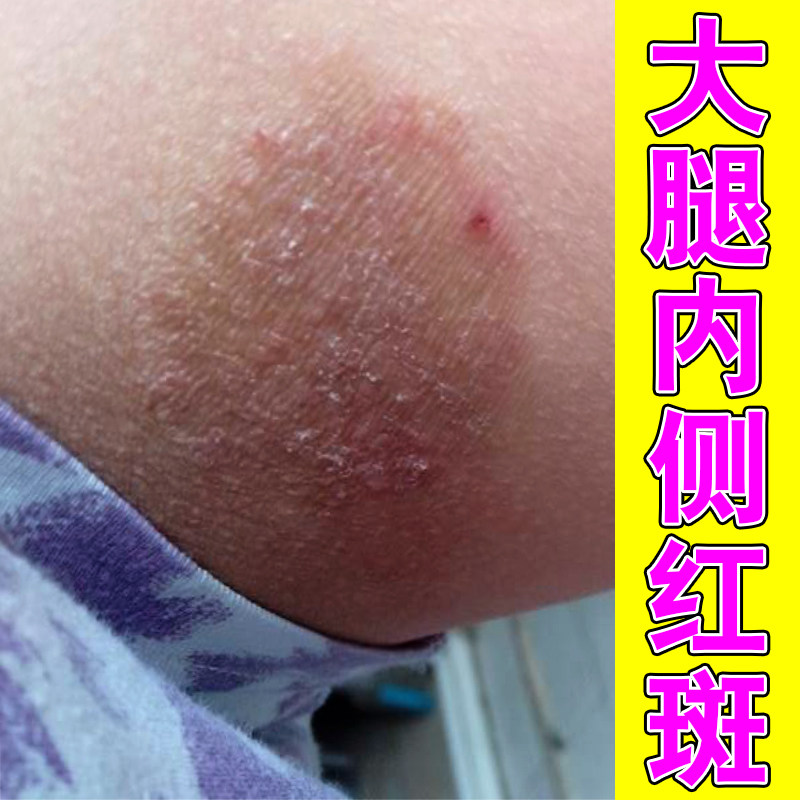 冶大腿根长红斑严重大腿根部皮肤痒屁股痘痘红疹外用草本修护乳膏
