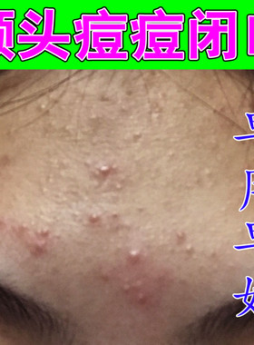 额头上长痘痘闭口粉刺草本乳膏儿童脸上起小疙瘩青春痘专用修复膏