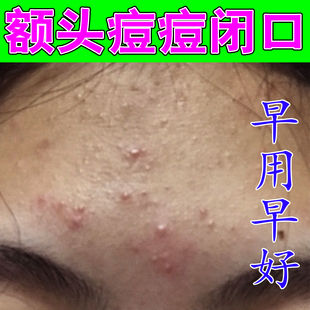 额头上长痘痘闭口粉刺草本乳膏儿童脸上起小疙瘩青春痘专用修复膏
