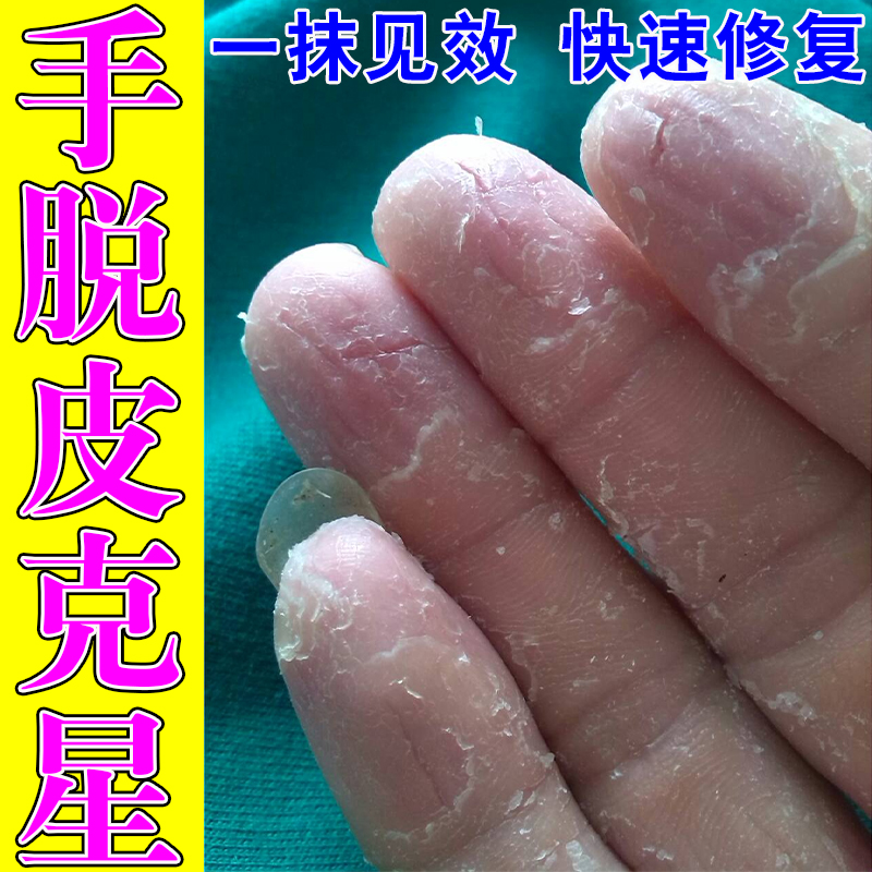 手脱皮药膏真菌感染严重手脚爆皮痒手上起皮干燥脱皮专用修复药膏