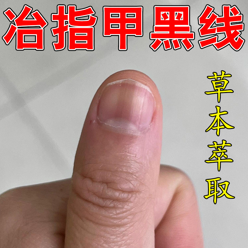 冶指甲黑纹专用指甲黑色黑斑手指甲长黑纹甲母痣专用草本修护液