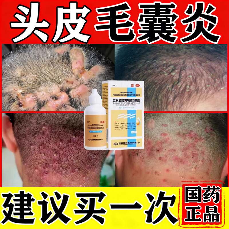 头皮毛囊炎特新效药治疗马拉色菌药膏洗发水克林霉素甲硝唑搽剂嚓