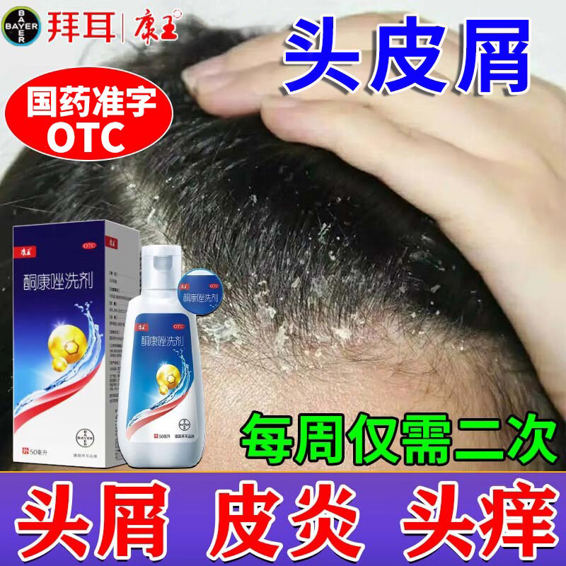 康王酮康唑洗剂头皮屑治疗药头皮痒脂溢性皮炎毛囊止痒去屑