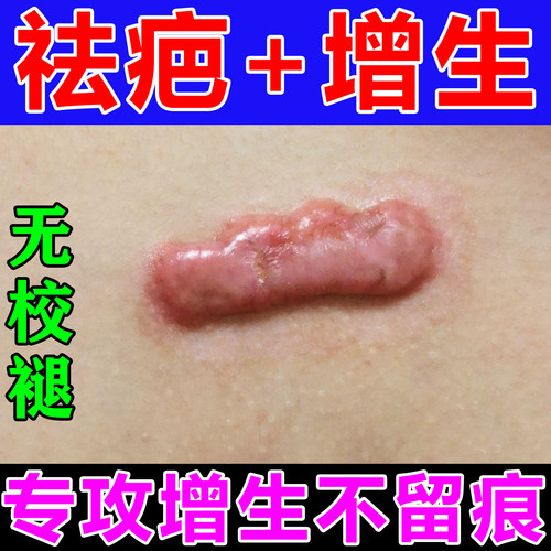 胸前瘢痕疙瘩增生凸起修复膏