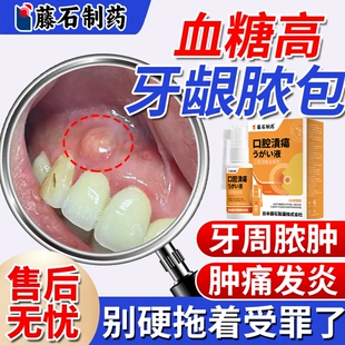 牙龈脓包肿痛消炎专用糖尿病非治疗牙周炎的漱口水药房发炎牙根YS