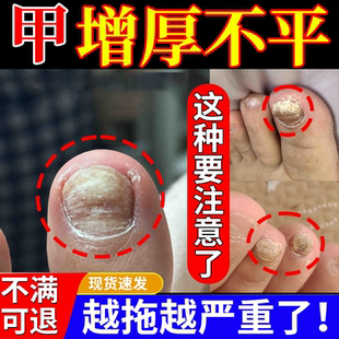 脚指甲变厚变硬专用去灰指甲厚黄增厚用什么药房同款除真菌感染YY