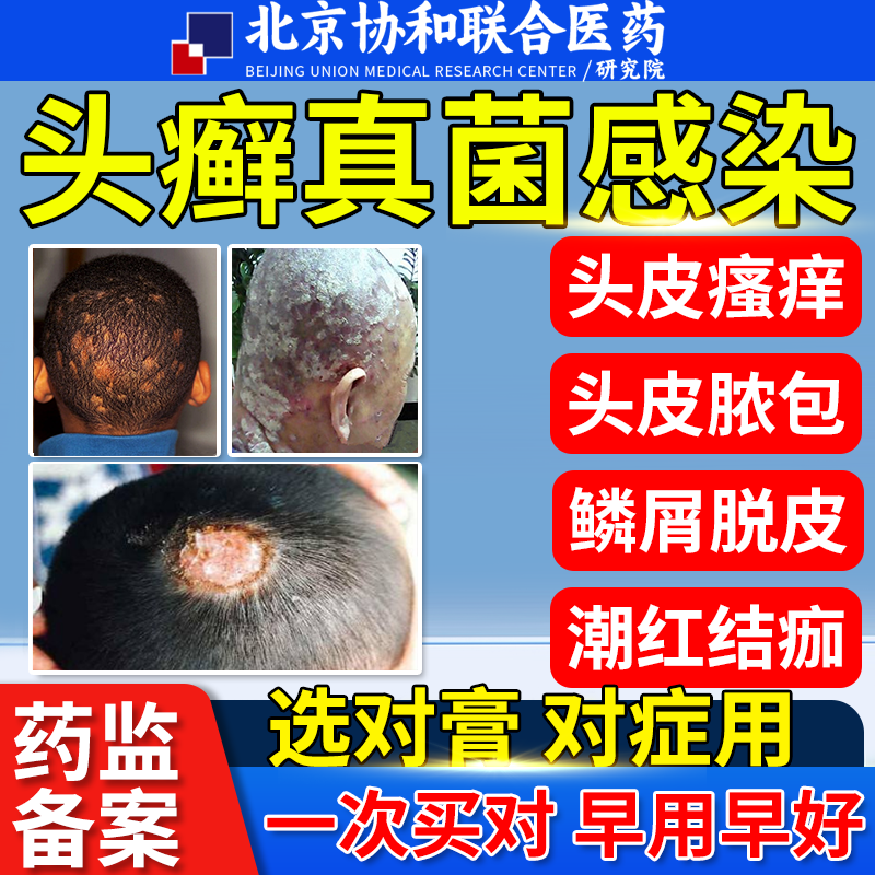 头癣膏头部银屑癣真菌感染头痒头皮癣毛囊炎儿童脂溢性药房售ozd