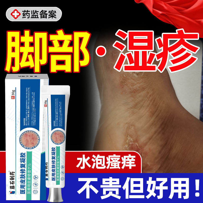 脚上水泡湿疹止痒去脚部根脚背长小水泡的药脚底又痒又起脱皮痒YS