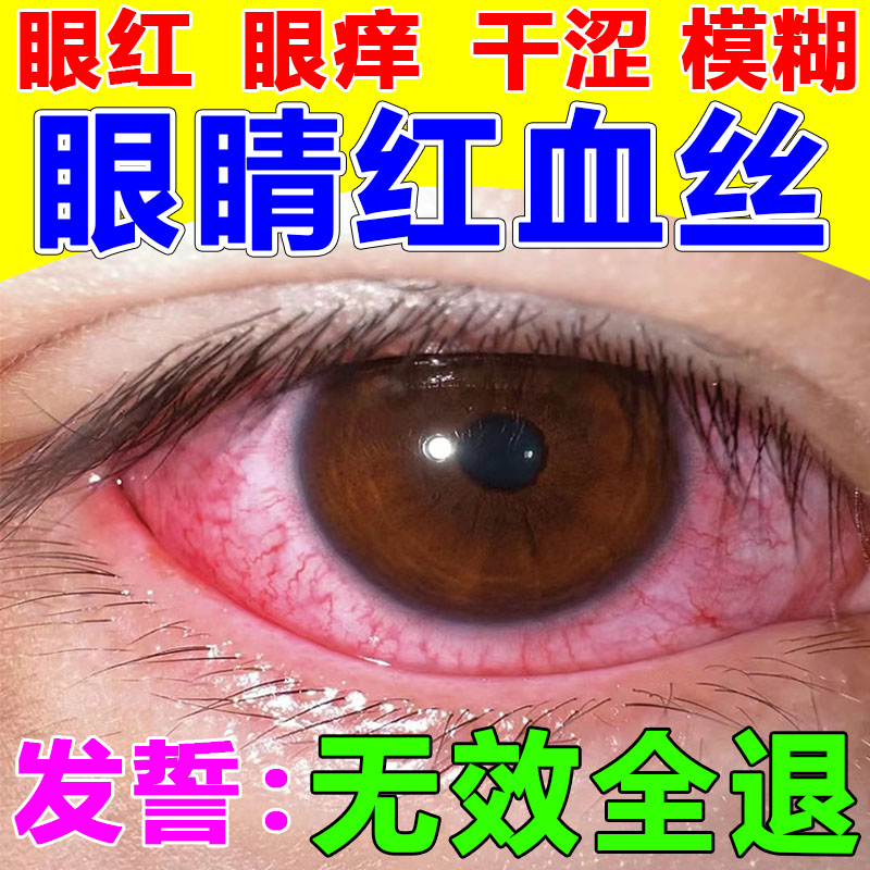 消除眼睛红血丝修复去除改善眼抗疲劳干涩发痒缓解眼屎多黄眼药水