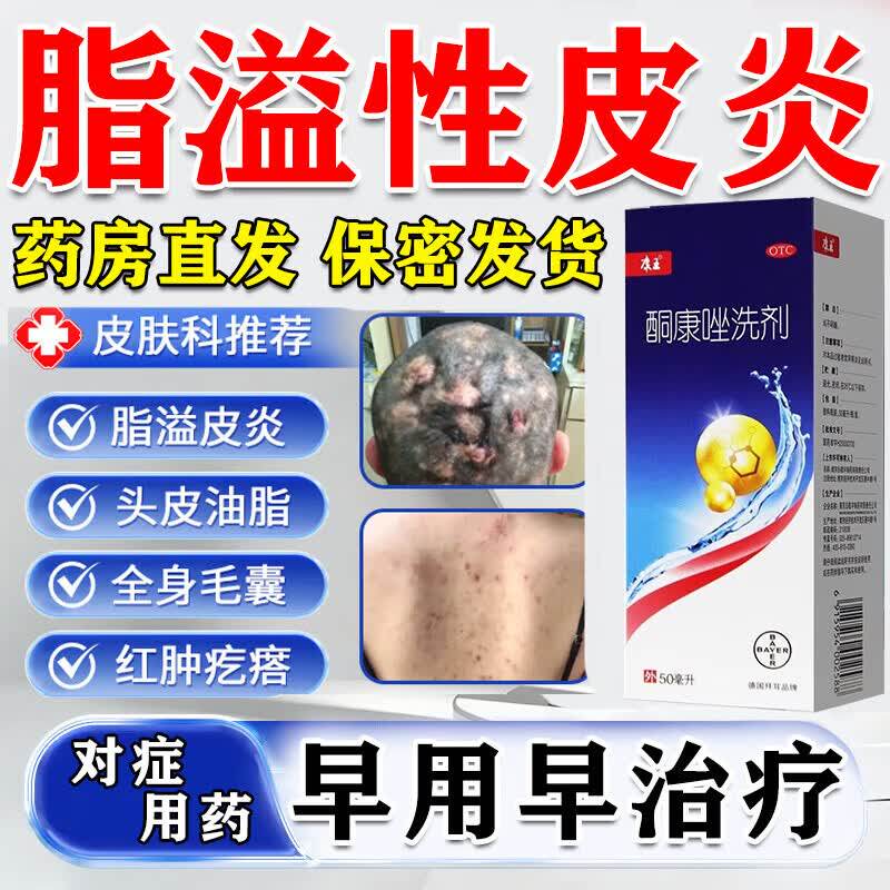 康王酮康唑洗剂治脂溢性皮炎去屑止痒洗发水皮炎毛囊炎专用药