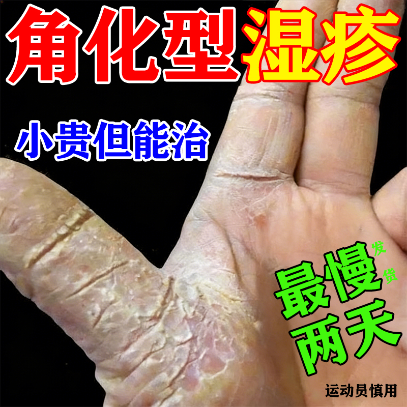 角化型湿疹手部皮炎专用手癣脱皮干裂真菌感染药膏手足皲裂口粗糙
