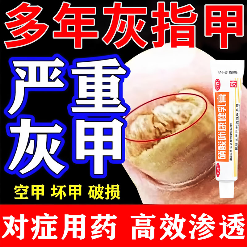 硝酸咪康唑乳膏灰指甲专用特非效药根甲治第一名真菌感染脚气