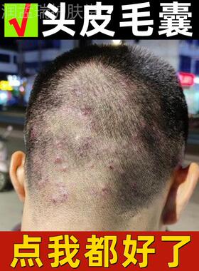 速发头皮癣皮囊炎苗家药膏毛襄炎药头皮藓药百草毛皮囊炎头皮
