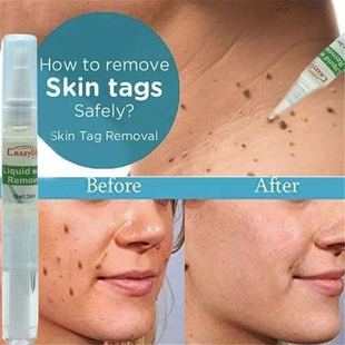 Skin Mole Corn kill Remove NWart Remover Genital 极速Tu &amp