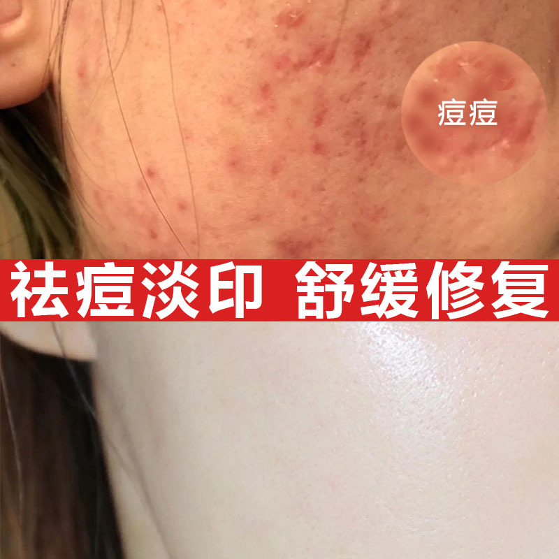 草本祛痘膏淡化痘印修复痘坑去粉刺痤疮青春痘控油祛痘修复霜