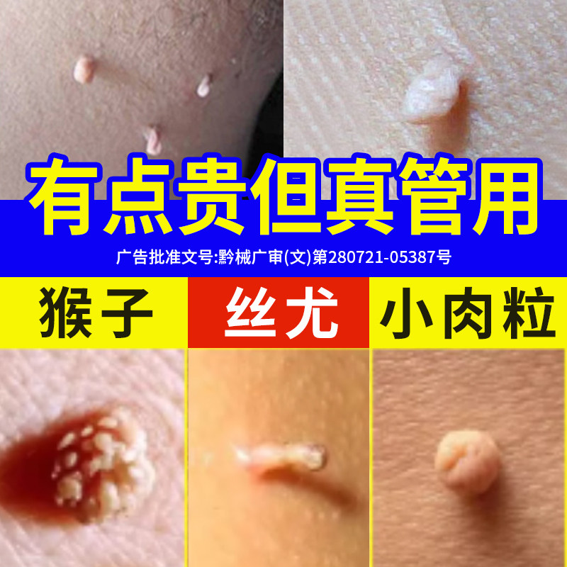 去疣瘊小肉粒疙瘩去脖子上肉球丝状疣扁平疣软膏皮赘猴子去除神器