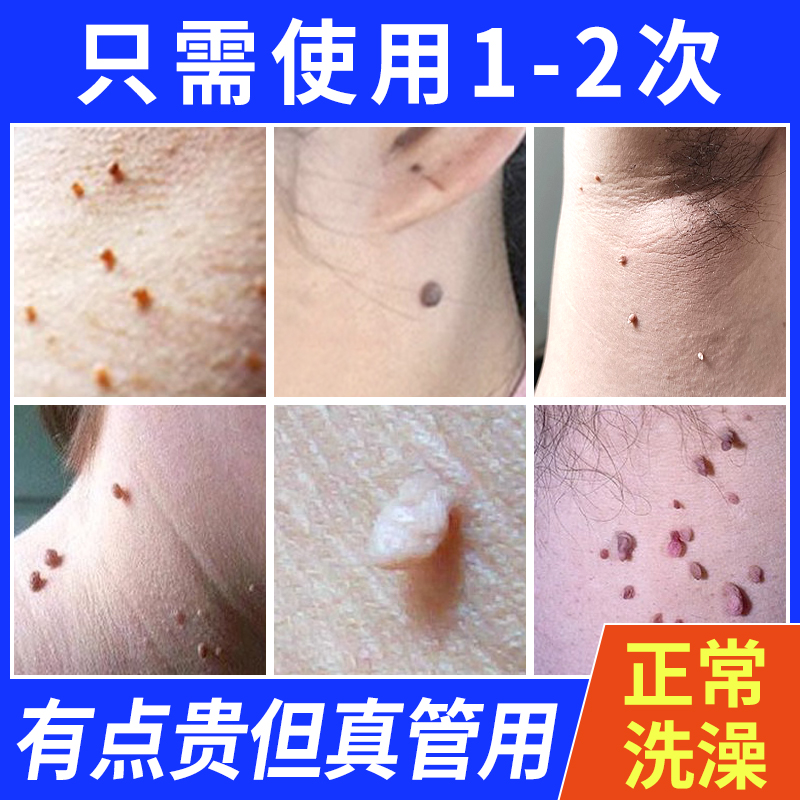 尤猴去脖子上长小肉球皮赘咯吱窝猴子肉粒一抹无忧疙瘩神器膏去除