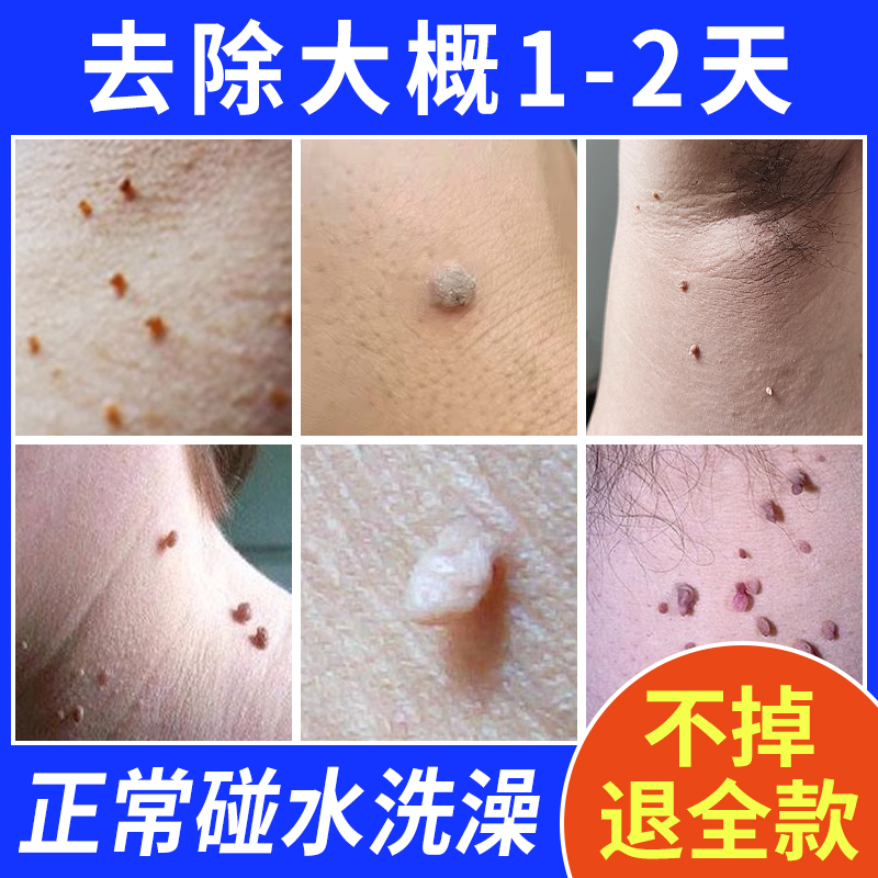 尤猴去脖子上长小肉粒腋下咯吱窝脸上猴子一抹无忧疙瘩神器膏去除
