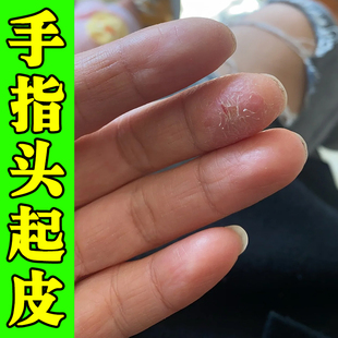 手足脱皮专用蜕皮手指手掌干燥起皮掉皮开裂口乳膏